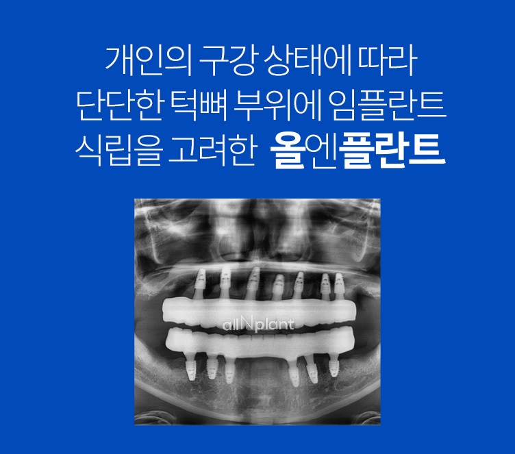 개인의 구강상태에 따라 단단한 턱뼈부위에 임플란트 식립을 고려한 올엔플란트